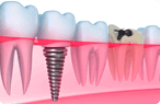 Crowns/Bridges - Dentist in Glendale