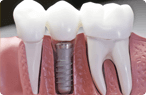 Glendale Dental Implants