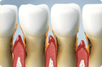 Glendale Periodontal Treatment