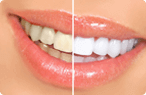 Teeth Whitening - Dentist in Glendale